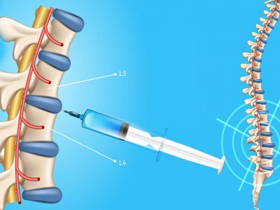 puncion-lumbar-1280x720